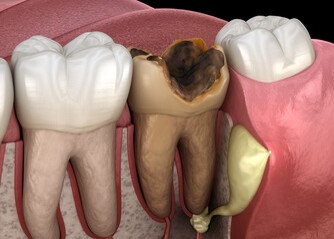 Las 2 causas de los flemones dentales.