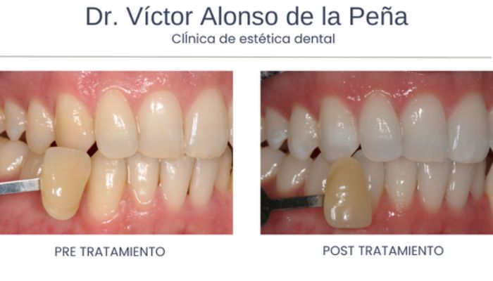  ¿Sueñas con una sonrisa más blanca?